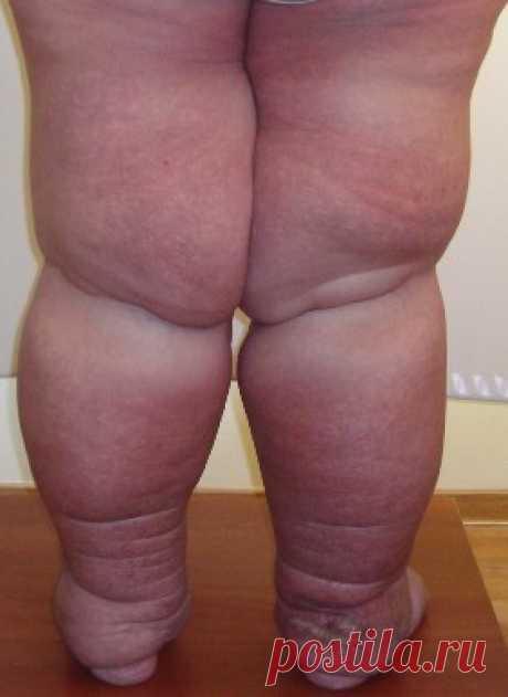 Лимфостаз нижних конечностей: лечение и фото симптомов болезни
