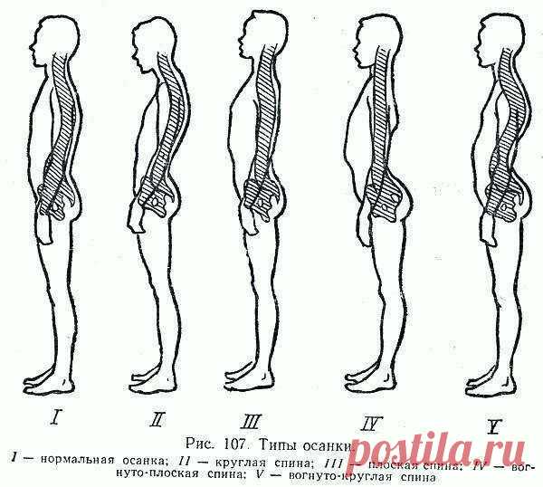 Сколиоз.