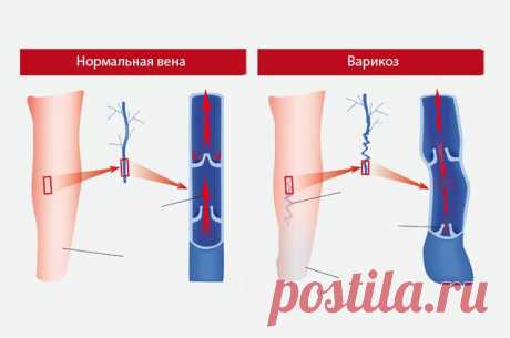 Варикозное расширение вен: причины, симптомы, лечение и профилактика
Судя по статистике, опубликованной на сайте клиники общей хирургии лечебного факультета РНИМУ им. Н. И. Пирогова, варикозным расширением вен на ногах страдает более половины населения земного шара.