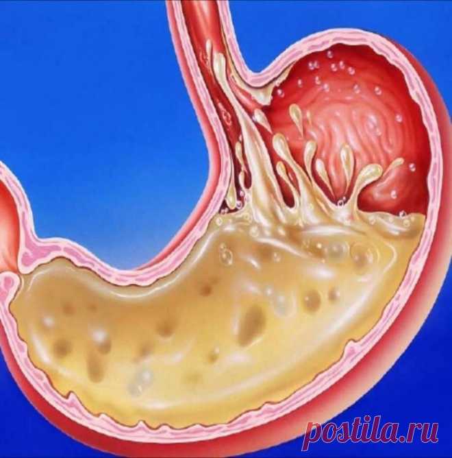 Раздраженный пищевод. Болезнь желудка рефлюкс эзофагит. Слизистая оболочка желудка гиперемирована.