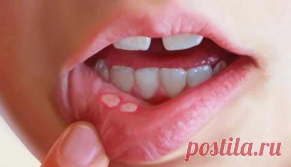 Как лечить язвочки во рту