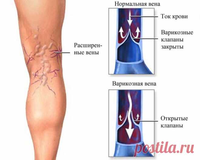 Варикоз на ногах — диагностика, лечение и профилактика