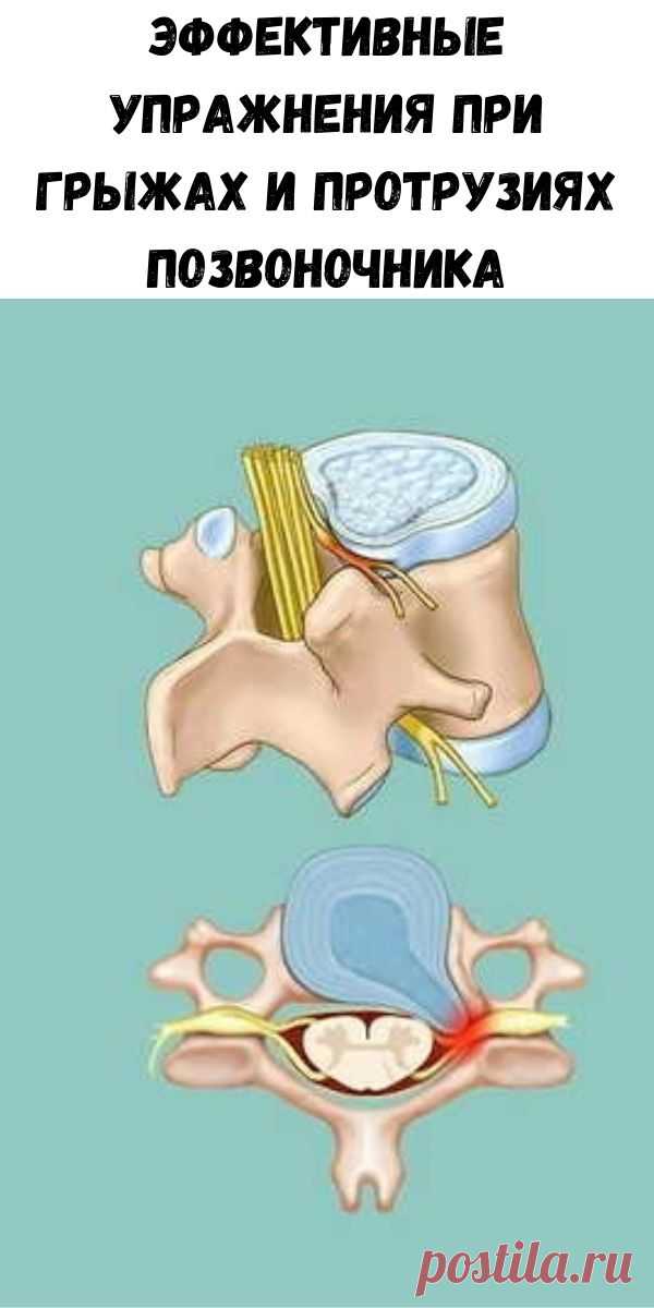Как лечить протрузию. Протрузия. Протрузии позвоночника. Грыжи и протрузии позвоночника. Упражнения при грыже и протрузии позвоночника.