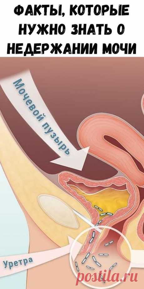 Факты, которые нужно знать о недержании мочи
Недержание мочи опасно. Как вылечить эту патологию дома?

Статистика показывает, что около 80% людей старше 50 лет страдают недержанием мочи. Причем в последние годы эта патология молодеет. По сравнению с прошлым годом на 14,5% возросло количество больных в возрасте от 30 до 45 лет.

Врачи не утешают: с возрастом болезнь будет только прогрессировать. И неприятные симптомы, в числе которых запах и пятна на одежде, никуда не исчез...