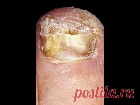 Грибок ногтей простое лечение  Nail fungus a Simple treatment