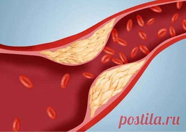 Советы врачей по быстрому снижению холестерина в крови | здоровье и спорт | Яндекс Дзен