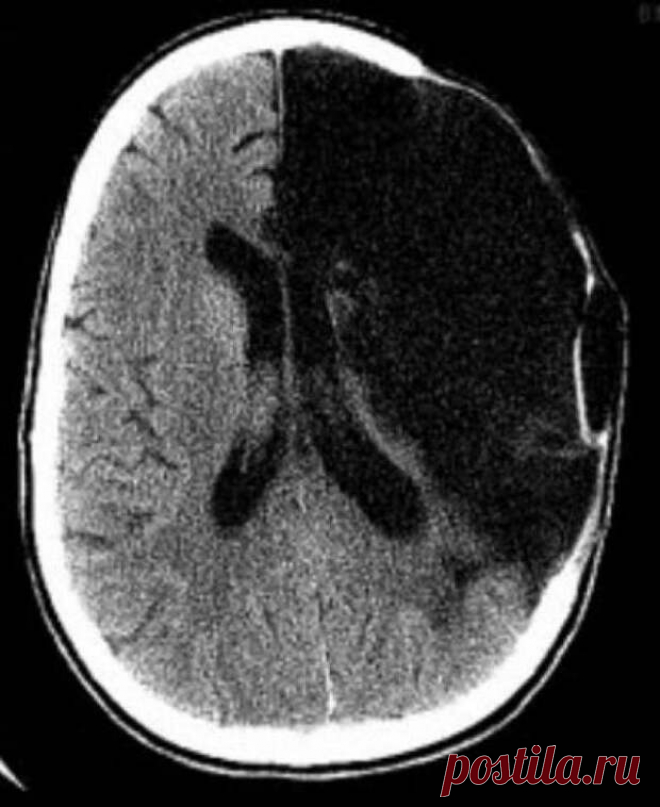 Последствия после обширного инсульта. Геморрагический инсульт кт. Обширный ишемический инсульт на кт. Ишемический инсульт снимок кт. Инсульт головного мозга кт ишемический и геморрагический.