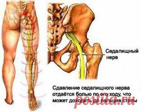 КАК УСТРАНИТЬ БОЛЬ В НОГЕ ОТ ВОСПАЛЕНИЯ СЕДАЛИЩНОГО НЕРВА.