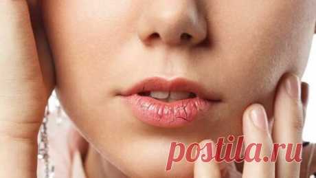 Основные причины, по которым трескаются губы, и как избавиться от этой проблемы