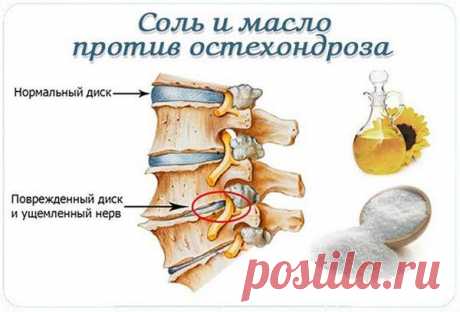 Народное средство от остеохондроза