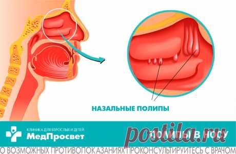 Нос может не дышать из-за полипов.

Полип носа (назальный полип) - доброкачественное новообразование слизистой оболочки и придаточных пазух носа.

 Образование полипов связано с гипертрофией (избыточным разрастанием) слизистой, которая может возникать из-за:
Показать полностью...