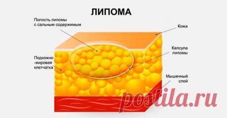 Вот, как избавиться от липомы быстро и легко! 4 народных рецепта со 100% эффективностью!