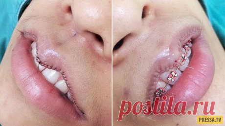 Уменьшение губ – новый тренд гламурных красоток (8 фото) | Чёрт побери