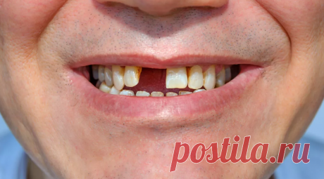 Какие ждут последствия, когда долго нет зубов? | Стоматология низких цен | ПромоСтраницы