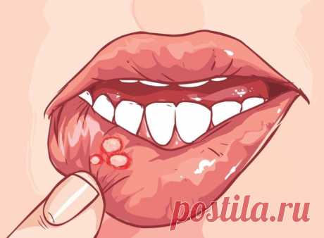 Стоматит — это воспаление слизистой оболочки рта. Есть несколько видов стоматита. Это язвенный, афтозный, везикулярный, герпетический и другие. Герпетический выглядит просто отвратительно. 
 
Самый частый — афтозный; это когда образуются такие маленькие язвочки на слизистой оболочке. Они противно щиплют, стоит пище попасть в рот, а также их всё время хочется потрогать языком (что только замедляет заживление). Конечно же, их ни в коем случае нельзя касаться пальцами и уж те...