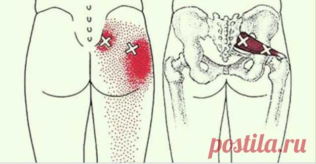 2 приема, которые разблокируют седалищный нерв и облегчат боль в течение нескольких минут!
