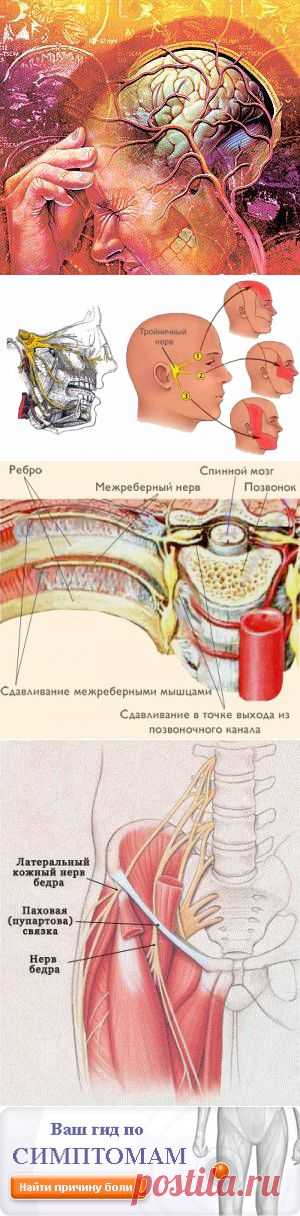 Невралгия - Причины, симптомы и лечение