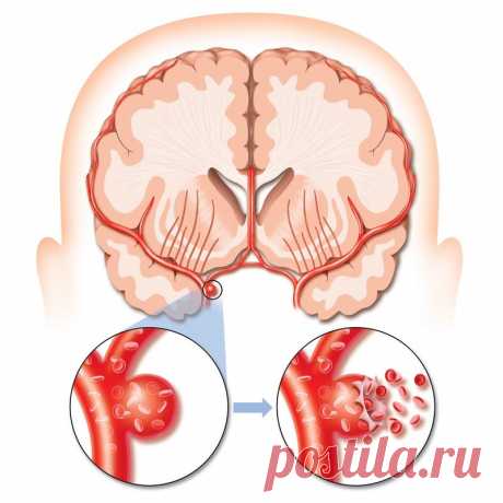 3 первых признака инсульта: запомните, чтобы спасти жизнь!