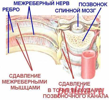 Межреберная невралгия: симптомы, лечение | ПолонСил.ру - социальная сеть здоровья