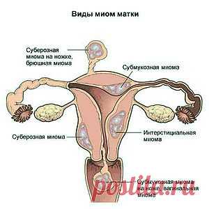 Причины развития миомы матки.