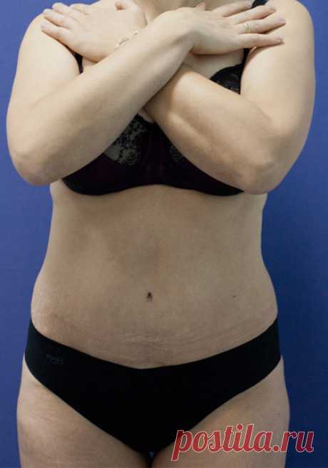 Увеличение груди, ринопластика, липосакция: отзывы | Beauty Insider