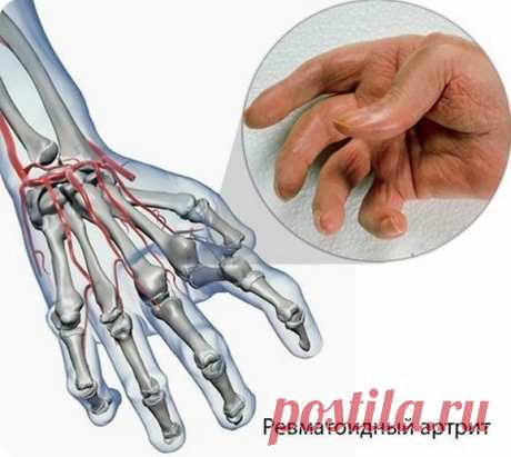 Первые симптомы ревматоидного артрита пальцев рук / Будьте здоровы
