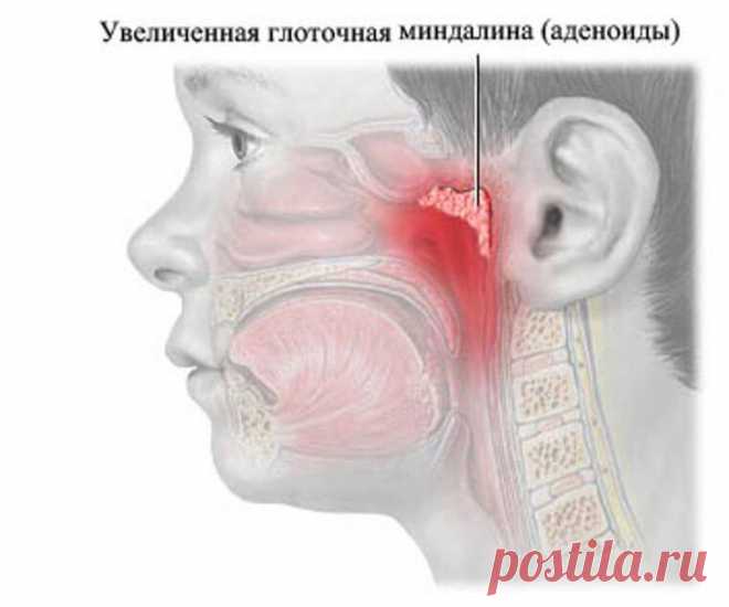 Миндалины и аденоиды фото