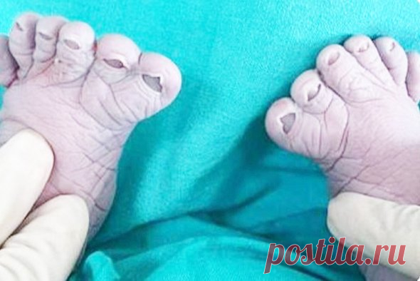 24-4-24--«Считайте пальчики, должно быть больше, чем надо-12»: жительница Уфы родила уже третьего ребенка с 12 пальцами на ногах | Мел