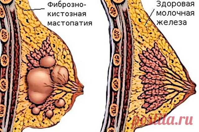 ОТ МАСТОПАТИИ эффективное старинное средство 

 
Существует эффективное древнее средство при мастопатии: в течение 10 дней прикладывать к опухоли на несколько часов тертую сырую свеклу. Затем 10 дней прикладывать на несколько часов марлю, смоченную водой с натертым хозяйственным мылом. 
 
Все это время желательно употреблять в пищу как можно больше свеклы и сок из нее. 
 
К такому лечению добавляется и лечение внутреннее – настойка перегородок грецких орехов (перегородки о...