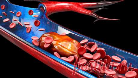 Сгустки крови моментально расщепляются: врач-кардиолог назвал лучший продукт против тромбов — закупорка сосудов больше не грозит - новости Хибины.ru Найден продукт, разжижающий кровь