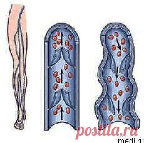 Тромбофлебит. Рецепты народной медицины для лечения тромбофлебита | Народная медицина