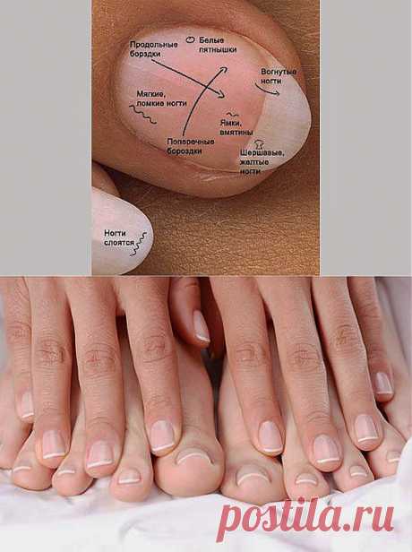 Определяем болезни по ногтям