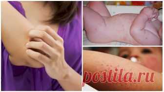 Лечение аллергии на укусы комаров у детей и взрослых
