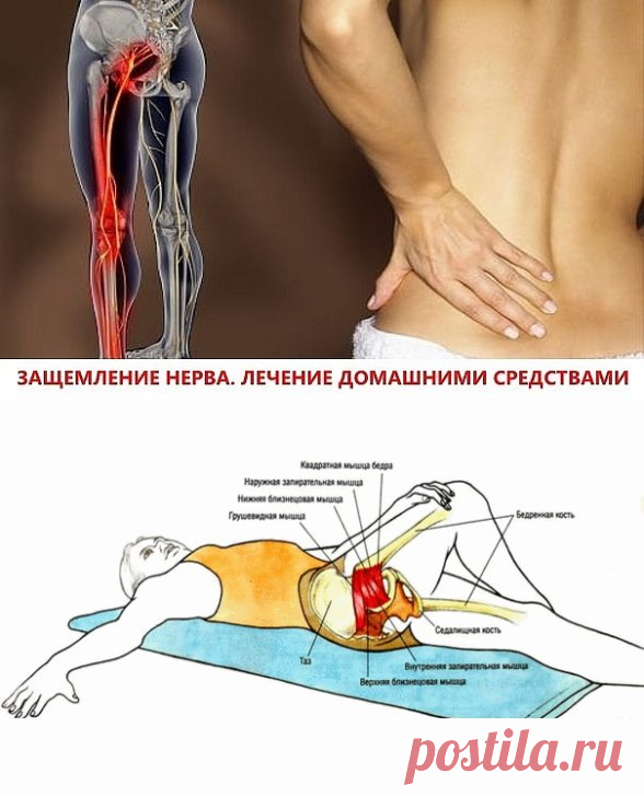 Боль в пояснице ягодице и ноге. Ущемление седалищного нерва симптомы. Седалищный нерв кровоснабжается. Защемление седалищного нерва s1. Защемляет седалищный нерв мышцей.