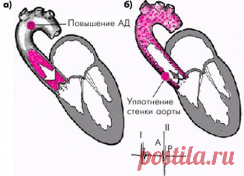 Уплотнение стенок аортального клапана