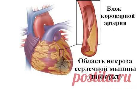 Народная медицина против инфаркта миокарда