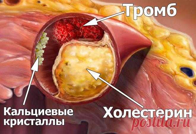 После такой чистки сосудов проходит диабет и ещё 7 якобы «неизлечимых» заболеваний