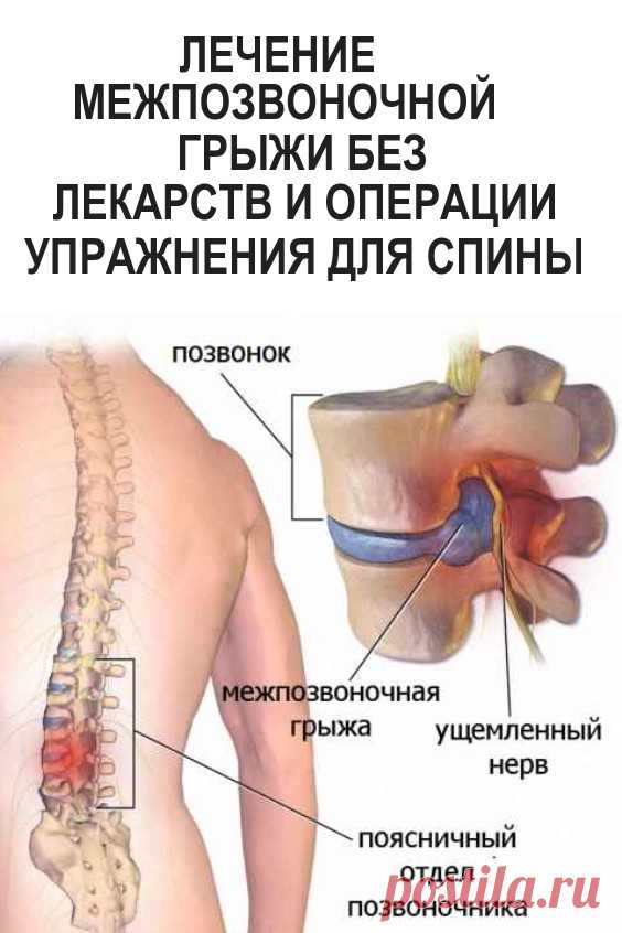 Удаления грыжи позвоночника поясничного отдела отзывы. Излечение межпозвоночной грыжи. Грыжа позвоночника без операции. Грыжа поясничного отдела.