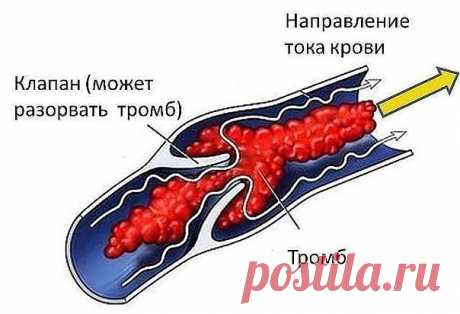 ТРОМБОЗ ГЛУБОКИХ ВЕН. 
ПЕЛАГЕЮ ПЕТРОВНУ ВСПОМИНАЮ ДОБРЫМ СЛОВОМ С вестником «ЗОЖ» знакома еще со страничек «Здоровый образ жизни», что печатались в «Советском спорте», то есть уже лет 10. С удовольствием читаю рецепты, которые предлагают читатели, и в свою очередь хочу поделиться своими. 
Когда мне было 28 лет, я перенесла операцию по поводу удаления камня из почки. После операции началось осложнение: появился тромбоз глубоких вен нижней конечности. 
В 33 года меня настоль...