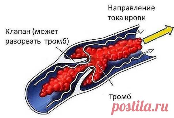 ТРОМБОЗ ГЛУБОКИХ ВЕН. 
ПЕЛАГЕЮ ПЕТРОВНУ ВСПОМИНАЮ ДОБРЫМ СЛОВОМ С вестником «ЗОЖ» знакома еще со страничек «Здоровый образ жизни», что печатались в «Советском спорте», то есть уже лет 10. С удовольствием читаю рецепты, которые предлагают читатели, и в свою очередь хочу поделиться своими. 
Когда мне было 28 лет, я перенесла операцию по поводу удаления камня из почки. После операции началось осложнение: появился тромбоз глубоких вен нижней конечности. 
В 33 года меня настоль...