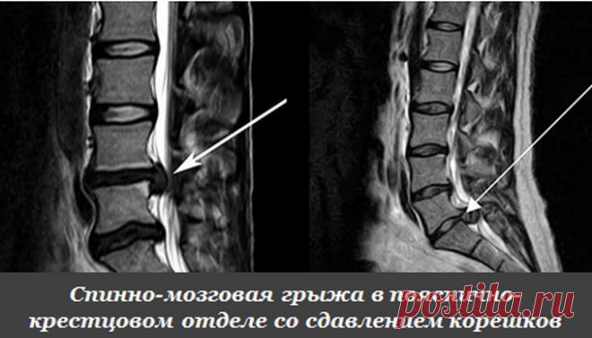 Межпозвоночная грыжа