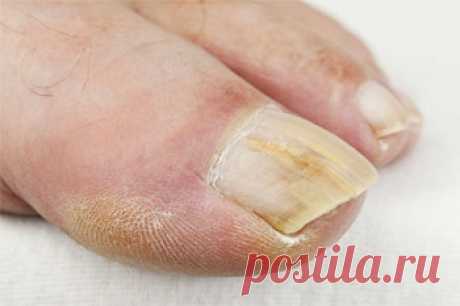 Грибок ногтей (микоз). Народные методы лечения