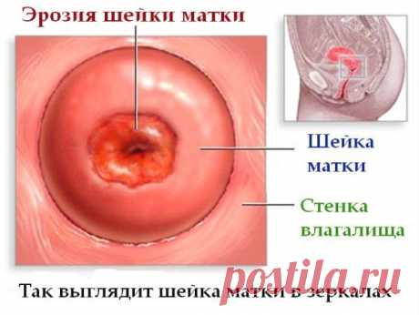 Что такое эрозия шейки матки, ее причины и последствия