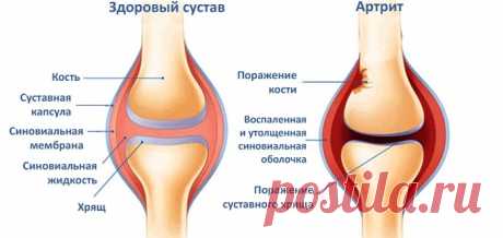 Болезни суставов и их лечение народными средствами.