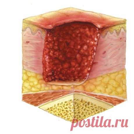 Глубокие пролежни – лечение глубоких пролежней.