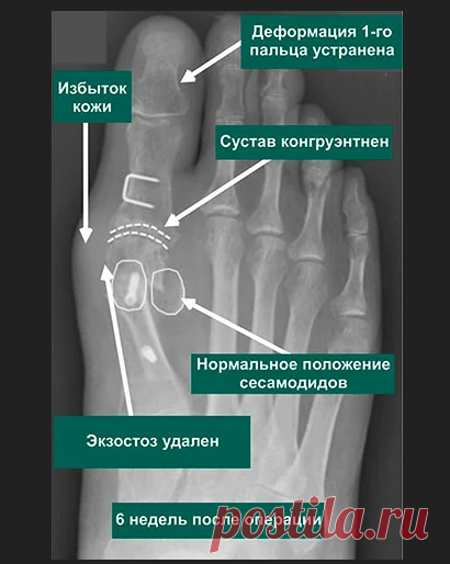 Вальгусная деформация стопы рентген фото