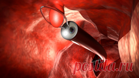 Полипы кишечника  Полипы кишечника - это небольшие доброкачественные новообразования, которые бессимптомно растут на его внутренней (слизистой) оболочке. Чаще всего встречаются