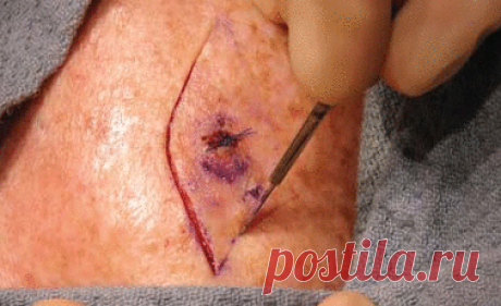 Базалиома кожи: симптомы, фото, лечение в начальной стадии