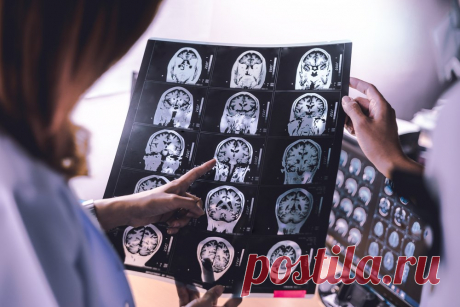 Как выглядит атрофия мозга? Причины и симптомы – Medaboutme.ru