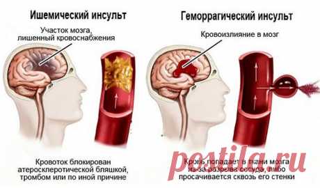 Инфаркт мозга: что это такое и чем отличается от инсульта